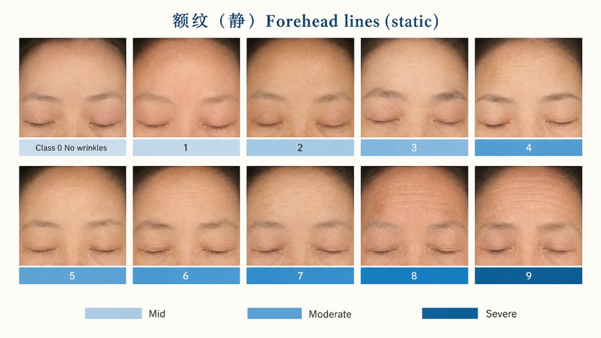 额纹静态分级 0–9